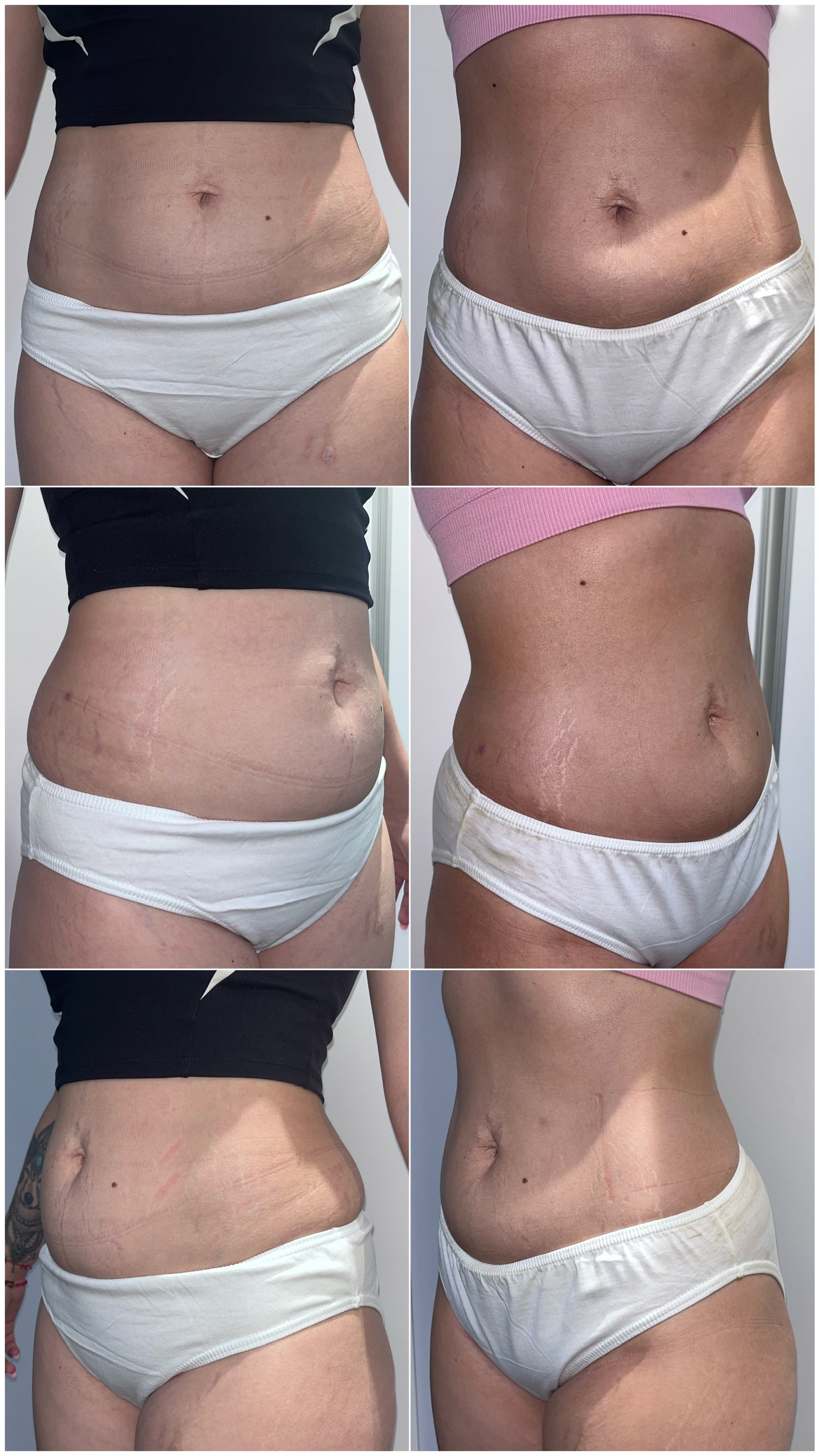 Tratamiento combinado de abdomen: 1 sesión Liposonix + HIFU y 6 sesiones EMS con Sculpt · 4 semanas