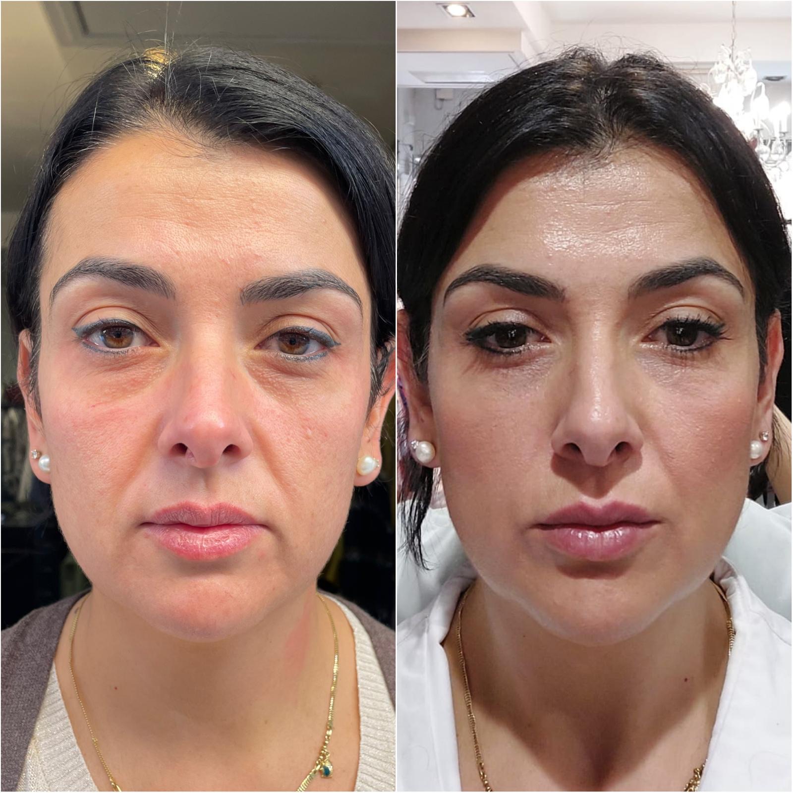 Plasma · evolución facial: 1 sesión · 30 días