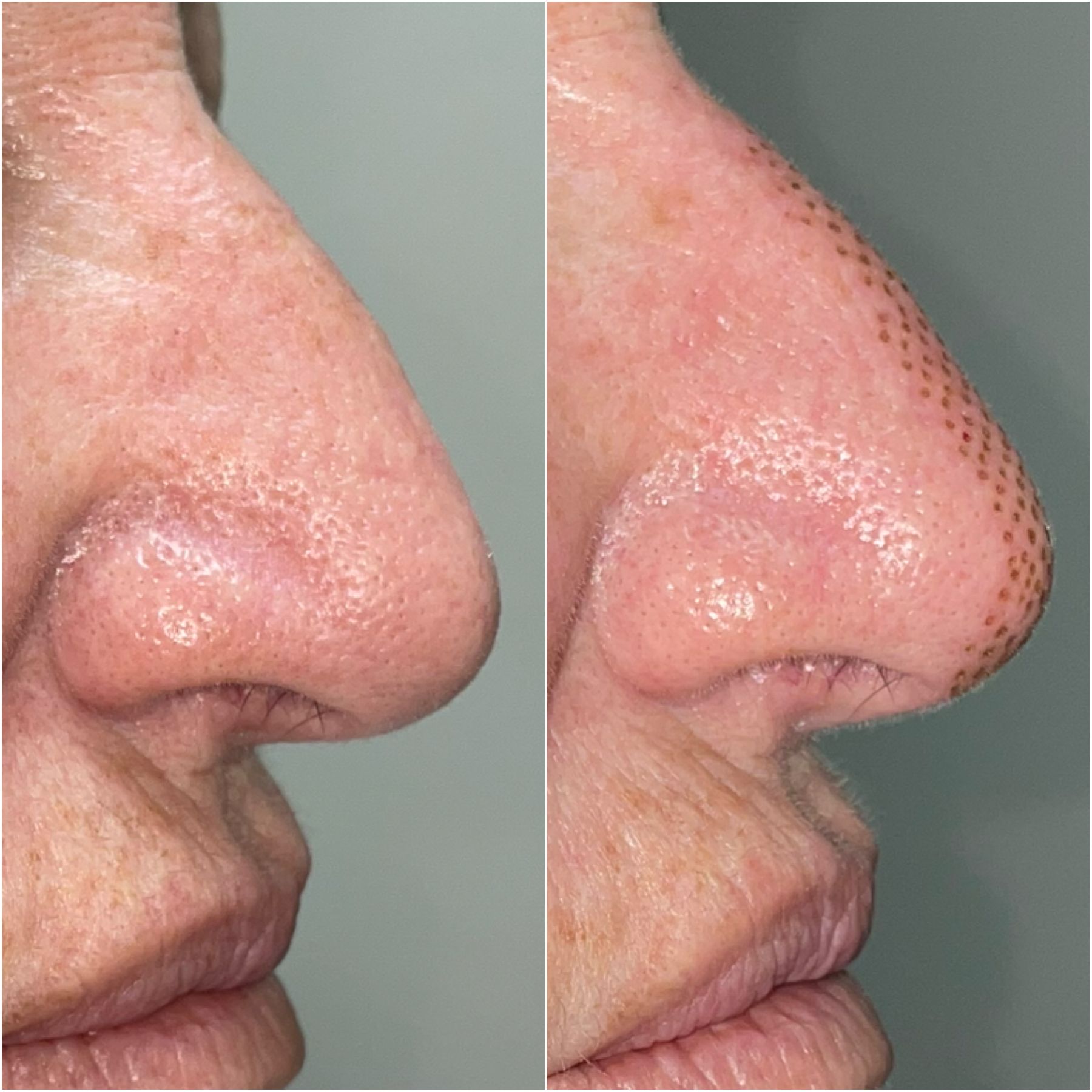 Plasma · zona nasal: 1 sesión · antes e inmediatamente después. La evolución posterior requiere seguimiento