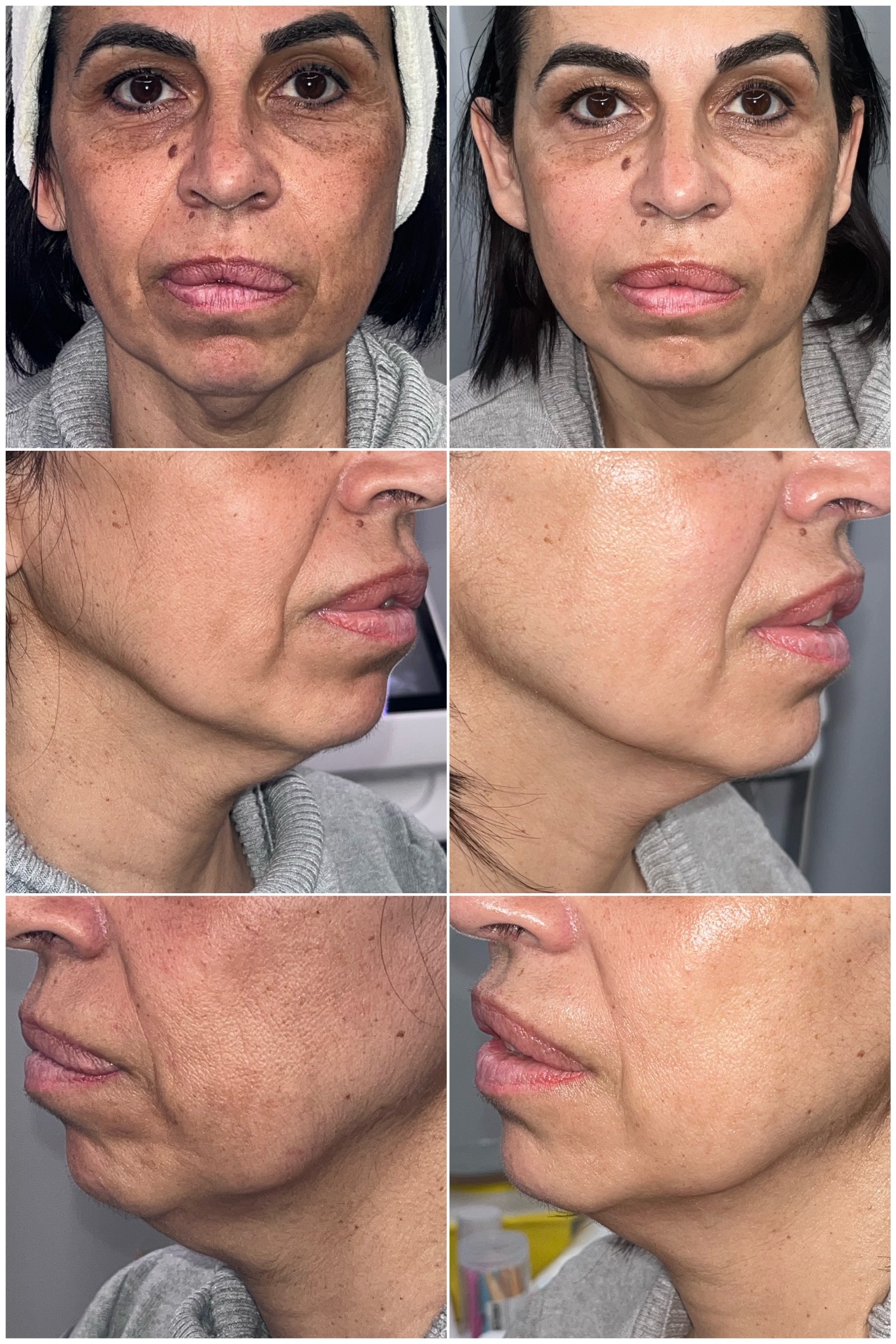 HIFU + DEP · 15 días: 1 sesión HIFU + 1 DEP con cóctel exclusivo · 15 días